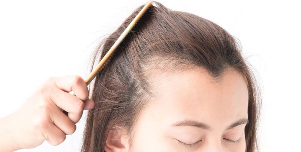 De oplossing voor dun haar bij vrouwen is in de meeste gevallen een haartransplantatie