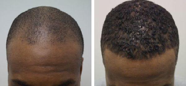 haartransplantatie Afro- kroeshaar