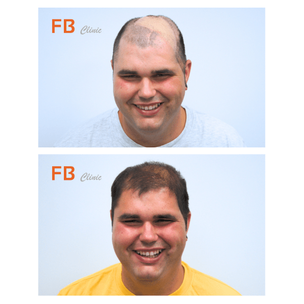 Succesvolle haartransplantatie bij FB Clinic: Het verhaal van Freddie Jansen !