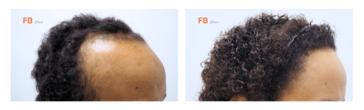 foto's voor en na haarlijn verlaging bij transgenders